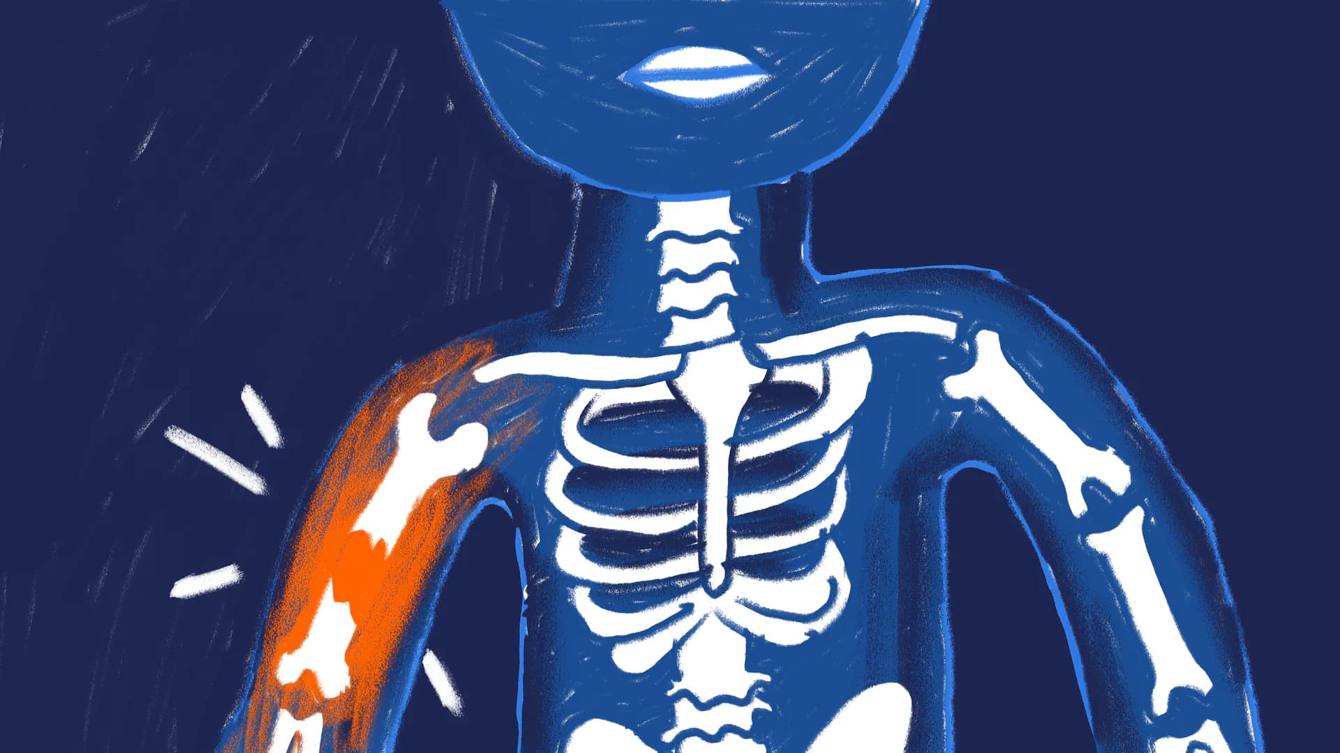 An illustrated X-ray showing a highlighted broken bone